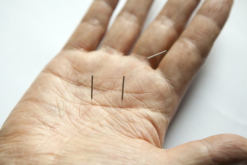 Acupuncture, moxibustion and cupping are all insured (1/3)