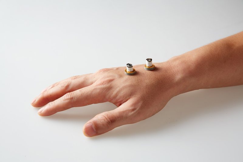 Acupuncture, moxibustion and cupping are all insured (3/3)